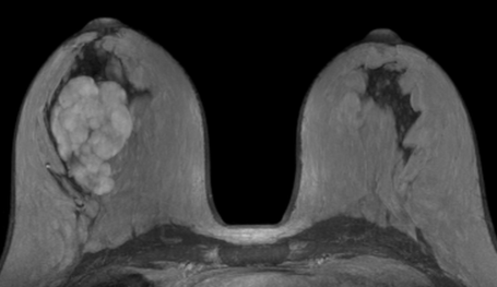 Grafik Tumor
